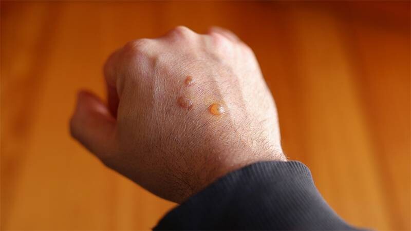 Nổi mụn nước không ngứa là gì?