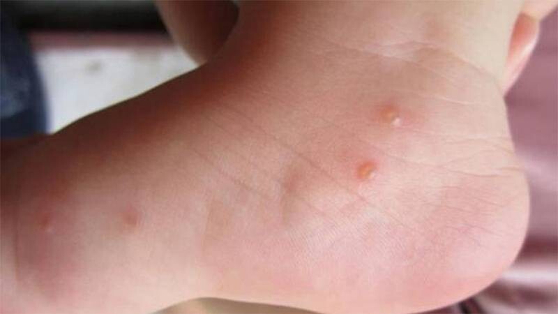 Nổi mụn nước không ngứa ở trẻ em có sao không?