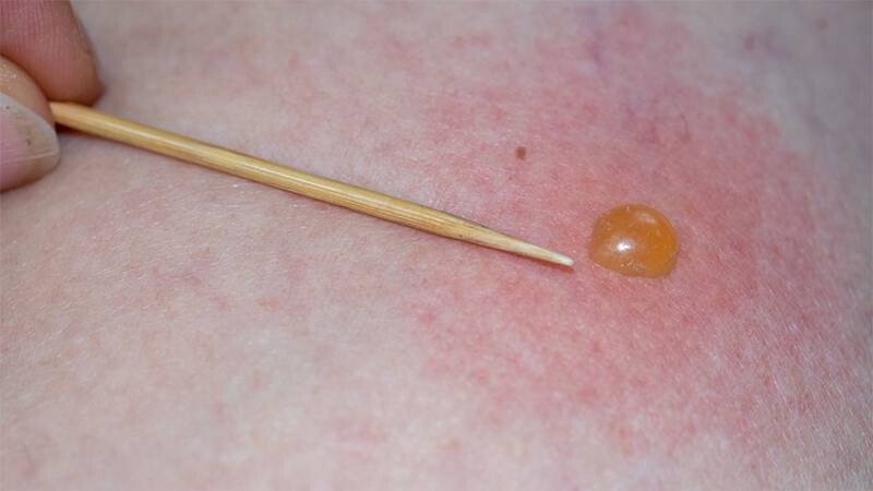 Nổi mụn nước không ngứa ở người lớn có gì đặc biệt?