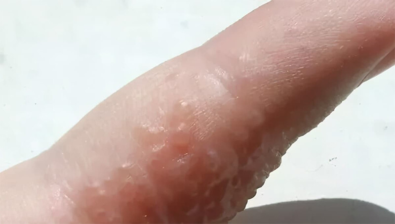 Dù nổi mụn nước không ngứa nhưng các bạn cũng không nên để vỡ mụn.