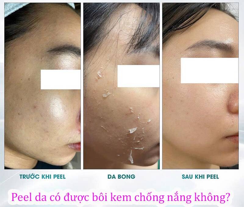 Peel da có được bôi kem chống nắng không? Đang peel da có được dùng kem chống nắng?