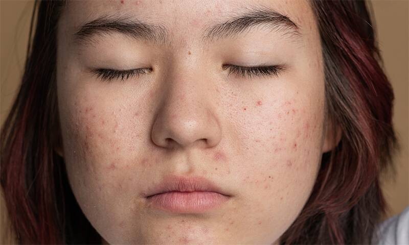 Đặc điểm da mụn tuổi dậy thì.