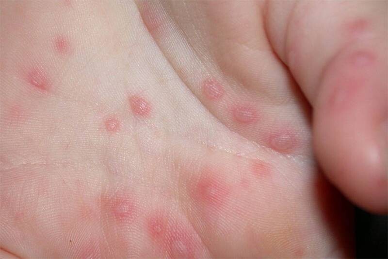 Trẻ em nổi mụn nước là gì?