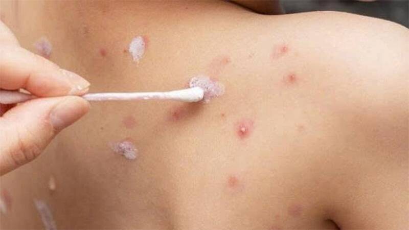 Trẻ em nổi mụn nước có thể do bị thủy đậu.