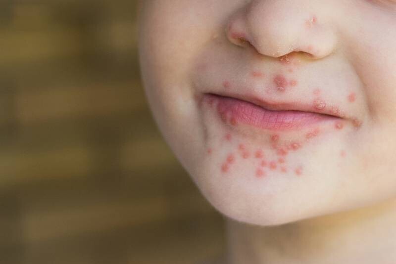 Cách phòng ngừa tái phát trẻ em nổi mụn nước.