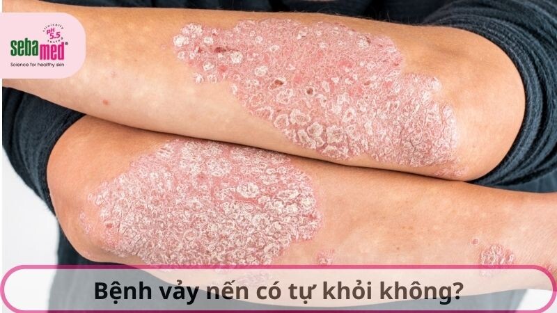 Bệnh vảy nến có tự khỏi không? 3 - 3 Vay Nen Co Tu Khoi Khong