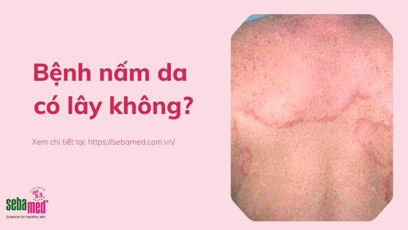 Bệnh nấm da có lây không?