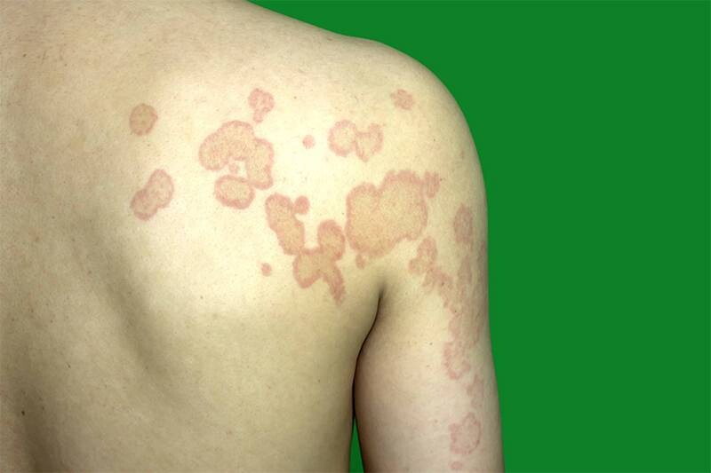 Bệnh nấm da là gì? Bệnh nấm da có lây không?