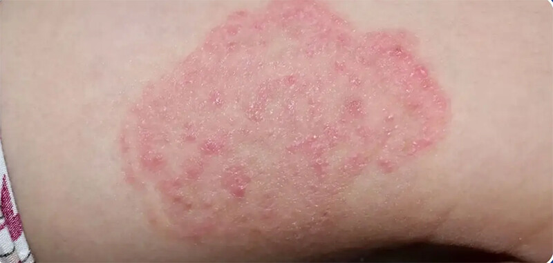 Bệnh nấm da có lây không? Cách phòng ngừa lây bệnh nấm da.