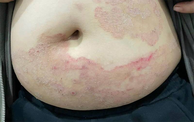 Bệnh nấm da có lây không? Bệnh nấm da có lây không?