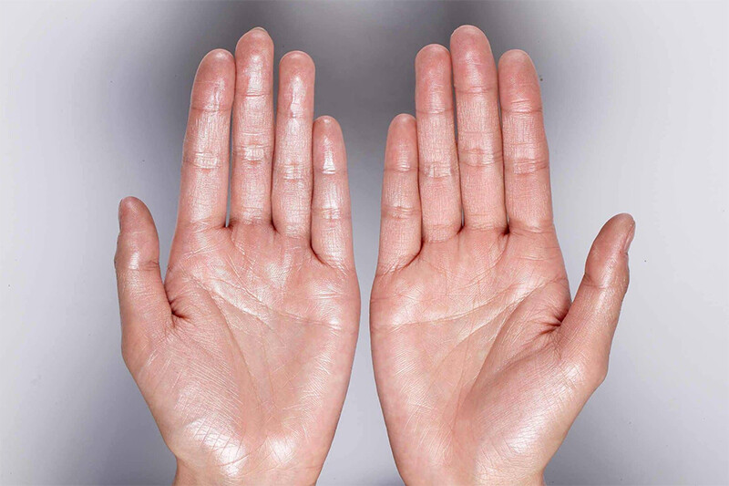 Bệnh ra mồ hôi tay chân có di truyền không? Ảnh hưởng bệnh ra mồ hôi tay chân.