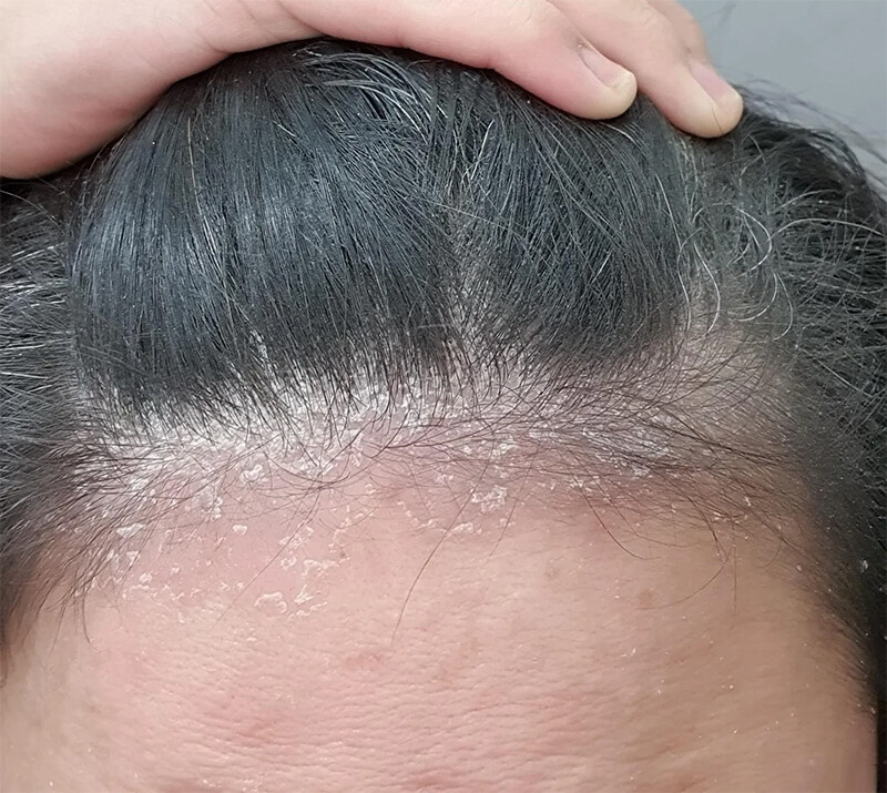 Bị gàu có lây không? 3 - 3 Bị gàu có lây không? Hướng dẫn cách chăm sóc ngăn ngừa gàu.