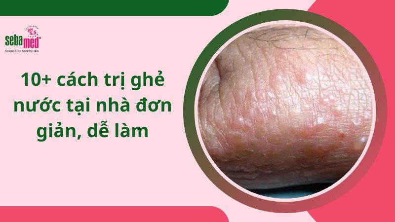 10+ cách trị ghẻ nước tại nhà đơn giản, dễ làm.