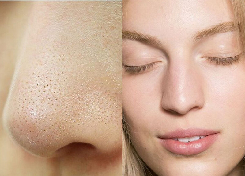 Cách trị mụn cám tại nhà bằng retinol giúp da đẹp sáng khỏe, sạch mụn.