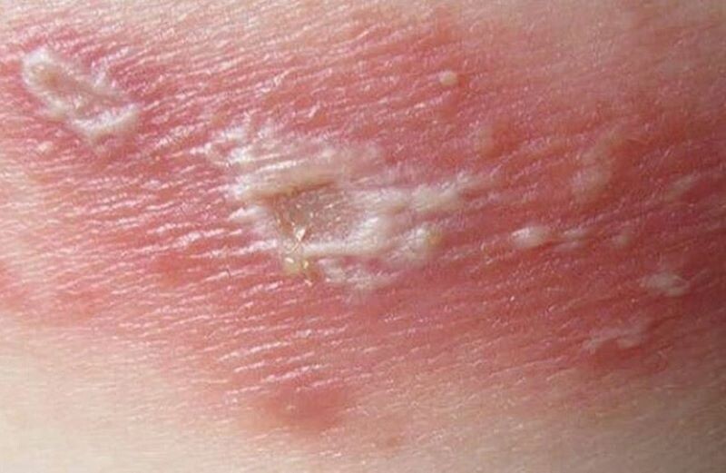 Cham Boi Nhiem Bao Lau Thi Khoi