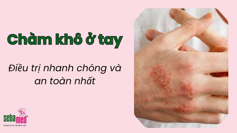 Chàm khô ở tay: Nguyên nhân và phương pháp điều trị 1 - 1 Cham Kho O Tay