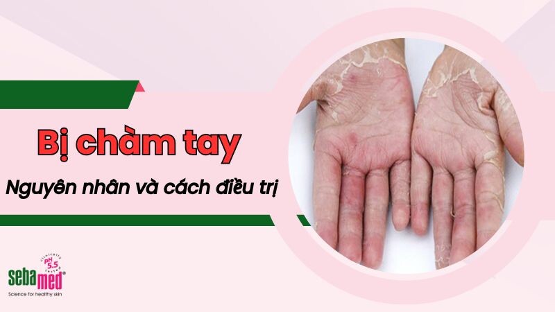 Bị chàm tay: Nguyên nhân và cách điều trị hiệu quả 1 - 1 Cham Tay