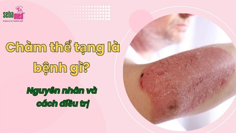Chàm thể tạng là bệnh gì? Nguyên nhân và cách điều trị 1 - 1 Cham The Tang