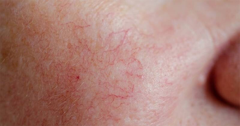 Da nổi chấm đỏ như nốt ruồi son không ngứa là bị gì? 3 - 3 Da nổi chấm đỏ như nốt ruồi son không ngứa có thể do vết mạch máu nổi.