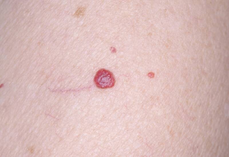 Da nổi chấm đỏ như nốt ruồi son không ngứa là bị gì? 4 - 4 Da nổi chấm đỏ như nốt ruồi son không ngứa có nguy hiểm không?