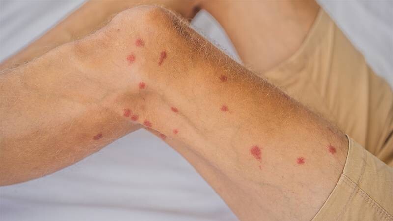 Da nổi chấm đỏ như nốt ruồi son không ngứa là bị gì? 5 - 5 Da nổi chấm đỏ như nốt ruồi son không ngứa: Khi nào cần đi khám bác sĩ?