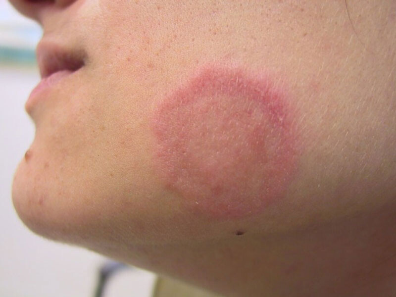 Dau Hieu Cham Da Mat