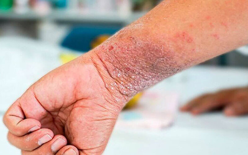 Chàm khô ở tay: Nguyên nhân và phương pháp điều trị 2 - 2 Dau Hieu Cham Kho O Tay