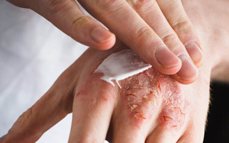 Bị chàm tay: Nguyên nhân và cách điều trị hiệu quả 4 - 4 Dieu Tri Benh Cham Tay