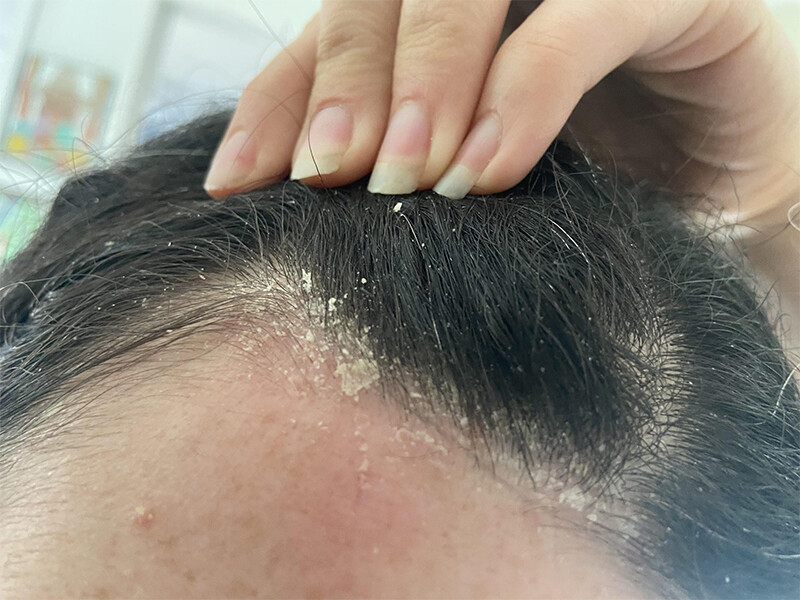 Gàu có gây rụng tóc không? Một số lưu ý ngăn ngừa gàu gây rụng tóc trở lại.