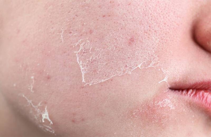 Da khô căng và bong tróc là hiện tượng sau khi peel da thường gặp.