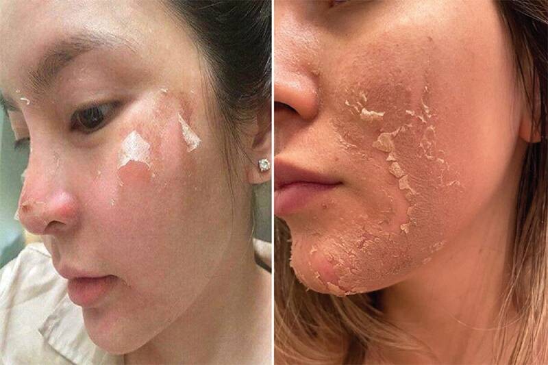 Không tự ý bóc lớp da đang bong tróc, hiện tượng sau khi peel da hay gặp nhất.