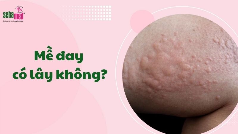 Mề đay có lây không? Giải đáp đúng bản chất để tránh hiểu lầm 2 - 2 Mề đay có lây không? Giải đáp đúng bản chất để tránh hiểu lầm