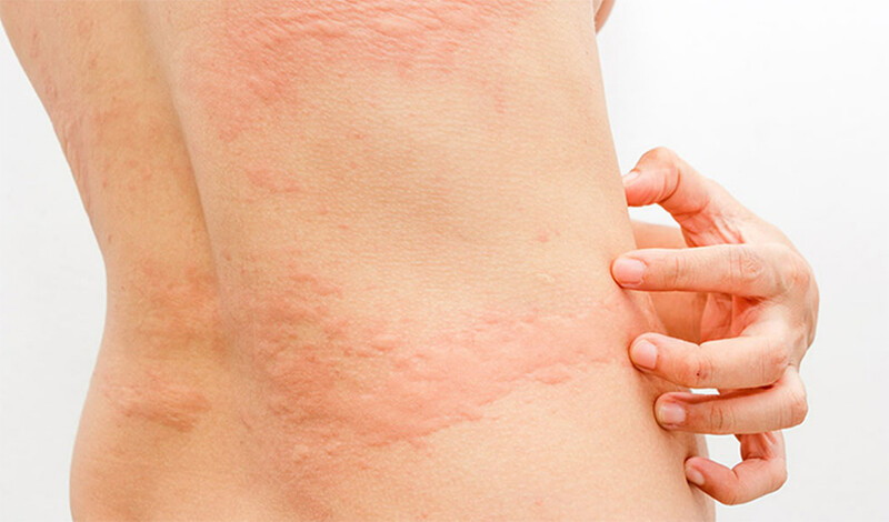 Mề đay có lây không? Giải đáp đúng bản chất để tránh hiểu lầm 1 - 1 Mề đay là gì? Mề đay có lây không?