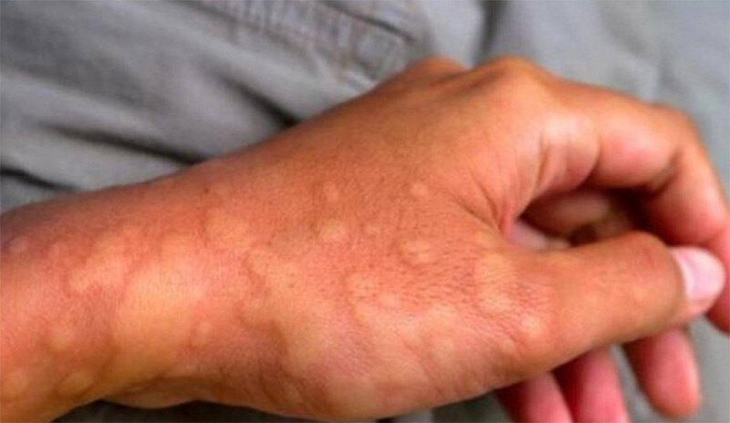 Mề đay có lây không? Giải đáp đúng bản chất để tránh hiểu lầm 3 - 3 Mề đay có lây không? Tình trạng khiến nhiều người lầm tưởng.