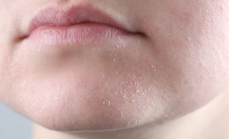 Mùa đông có nên dùng sữa rửa mặt không? 1 - 1 Mùa đông có nên dùng sữa rửa mặt không? Da vào mùa đông trở nên khô, nhạy cảm, bong tróc hơn.