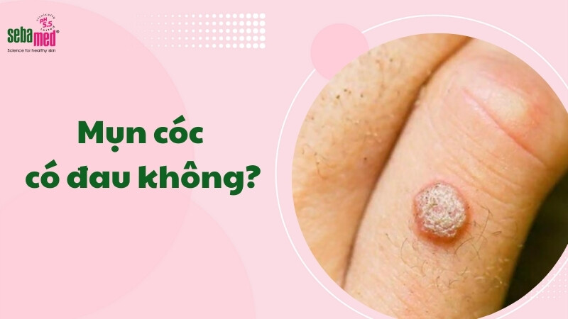 Mụn cóc có đau không?