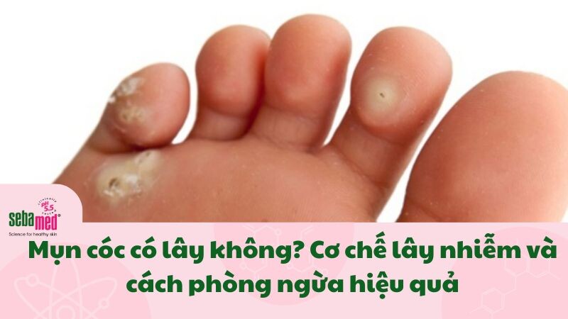 Mụn cóc có lây không? Cơ chế lây nhiễm và cách phòng ngừa hiệu quả 2 - 2 Mụn cóc có lây không? Cơ chế lây nhiễm và cách phòng ngừa hiệu quả.