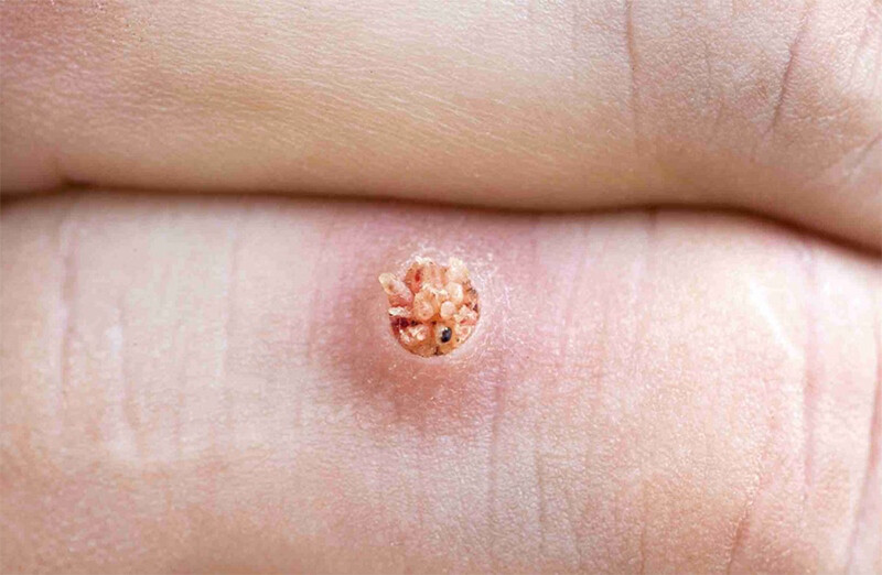 Mụn cóc có lây không? Cơ chế lây nhiễm và cách phòng ngừa hiệu quả 1 - 1 Mụn cóc là gì? Mụn cóc có lây không?