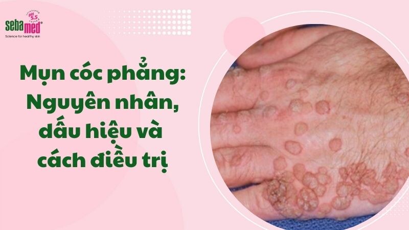 Mụn cóc phẳng: Nguyên nhân, dấu hiệu và cách điều trị 4 - 4 Mụn cóc phẳng: Nguyên nhân, dấu hiệu và cách điều trị