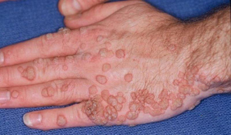 Mụn cóc phẳng: Nguyên nhân, dấu hiệu và cách điều trị 1 - 1 Mụn cóc phẳng là gì?