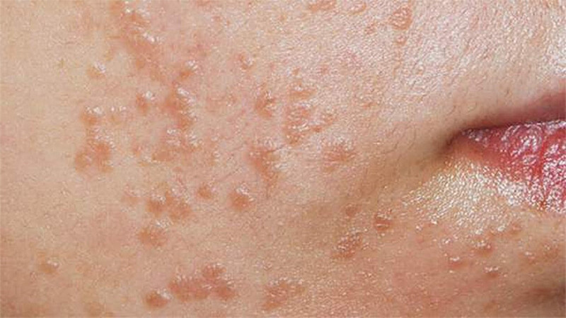 Mụn cóc phẳng: Nguyên nhân, dấu hiệu và cách điều trị 2 - 2 Mụn cóc phẳng có tự khỏi không?