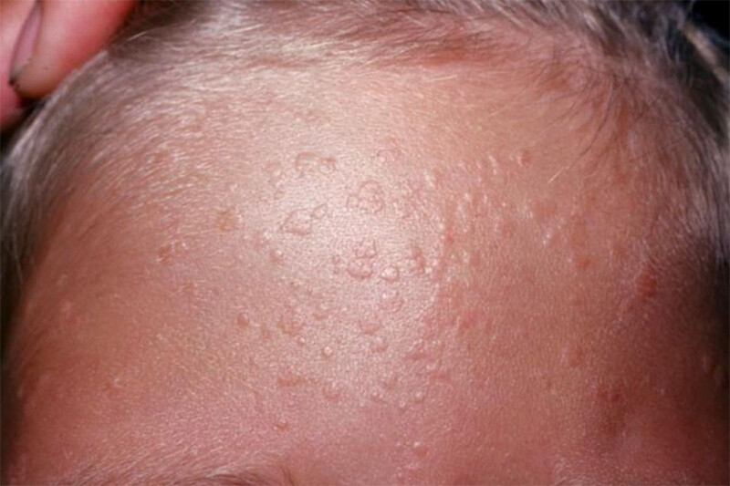 Mụn cóc phẳng: Nguyên nhân, dấu hiệu và cách điều trị 5 - 5 Cách điều trị mụn cóc phẳng theo khoa học.