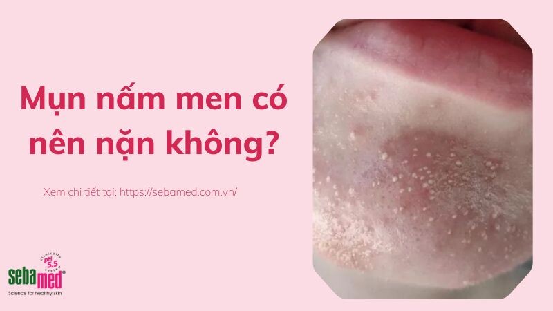 Mụn nấm men có nên nặn không?