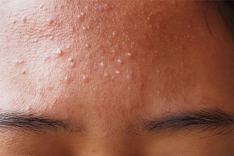 Mụn nấm men có nên nặn không? Cách điều trị mụn nấm men dứt điểm.