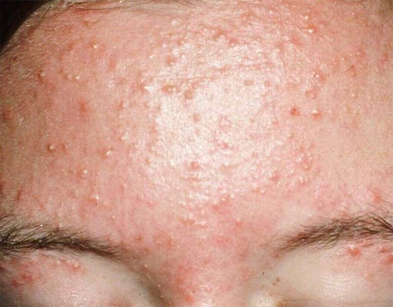 Mụn nấm men có nên nặn không? Mụn nấm men có tự khỏi không?