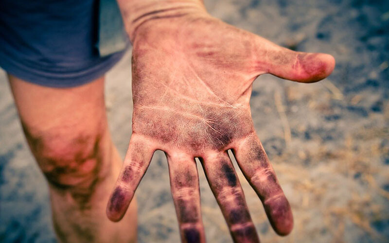 Bị chàm tay: Nguyên nhân và cách điều trị hiệu quả 3 - 3 Nguyen Nhan Bi Cham Tay