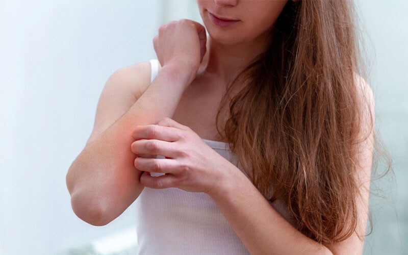 Chàm khô ở tay: Nguyên nhân và phương pháp điều trị 3 - 3 Nguyen Nhan Cham Kho O Tay