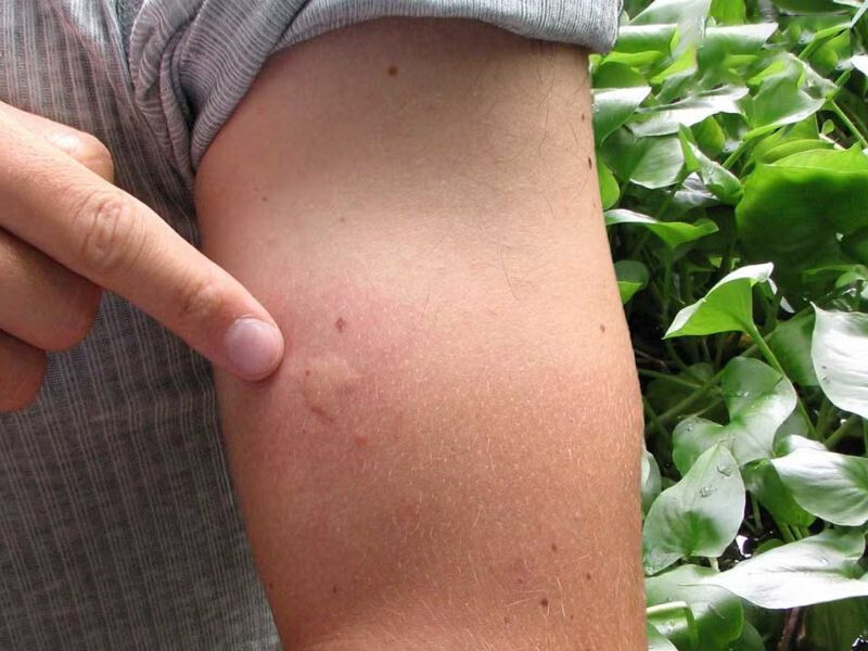 Nổi mẩn đỏ ngứa khắp người như muỗi đốt: Nguyên nhân và cách điều trị 1 - 1 Nổi mẩn đỏ ngứa khắp người như muỗi đốt là gì?