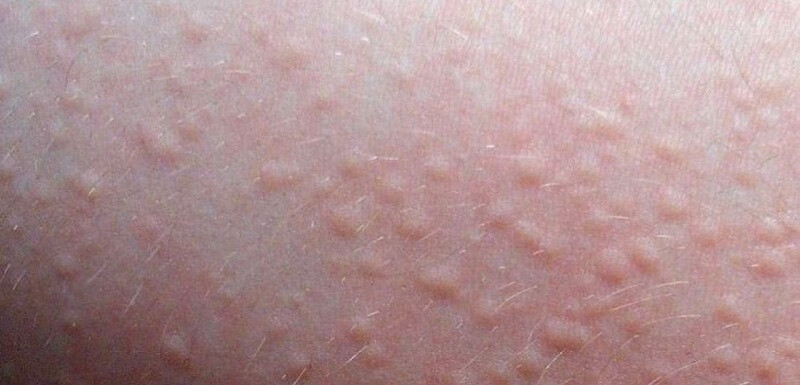 Nổi mẩn đỏ ngứa khắp người như muỗi đốt: Nguyên nhân và cách điều trị 4 - 4 Các phương pháp điều trị nổi mẩn đỏ ngứa khắp người như muỗi đốt.