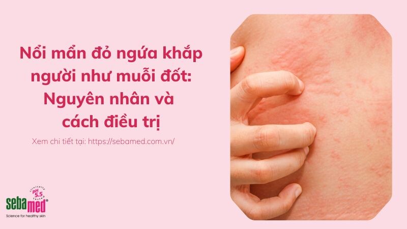 Nổi mẩn đỏ ngứa khắp người như muỗi đốt: Nguyên nhân và cách điều trị 2 - 2 Nổi mẩn đỏ ngứa khắp người như muỗi đốt: Nguyên nhân và cách điều trị.